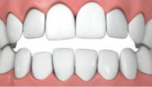 Offener-Biss-Invisalign.jpg Offener-Biss-Invisalign.jpg